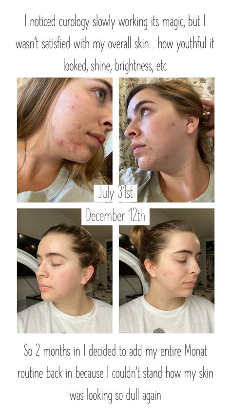 Monat Testimonials, Monat Before And After, Skin, Quick Saves