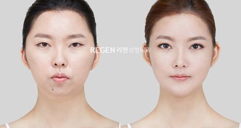 Two jaw surgery, V-line surgery, Zygoma reduction, Eye surgery, Nose surgery… Zygoma Reduction, Surgery Nose, V Line Surgery, Chin Implant, Jaw Surgery, Nose Surgery, I Attract, V Line, Eye Surgery