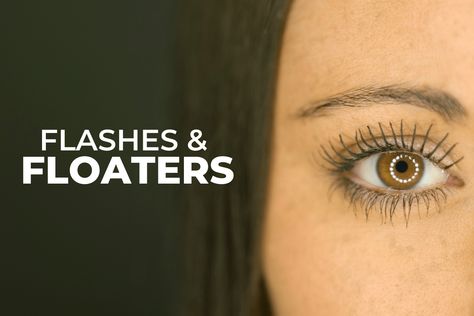 Eye Floaters Remedies Natural Treatments, Floaters In The Eye, Flashes Of Light In Eye, How To Fix Your Eyesight, Eye Floaters, Healthy Eyesight, What Causes Eye Floaters, Eye Twitching Causes Of, Eye Floaters Causes