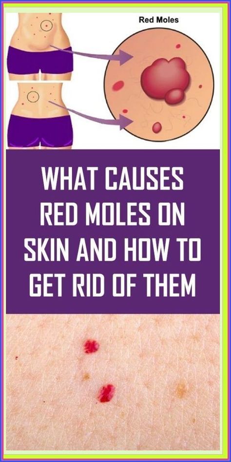 What Do The Red Moles On The Body Mean? Red Moles On Skin, Red Moles, School Communication, Health Planner, Medical Practice, Blood Vessels, Health Remedies, Mole, Hair Removal