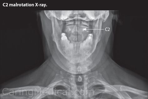 In this x-ray from one of our patients we can display a C2 malrotation. The dotted center line represents where the center of the C2 should be. We see that the C2 is shifter far over. Restoring the C2 to its natural position can alleviate swallowing difficulties as well as many symptoms attributed to cervical spine instability. Craniocervical Instability Symptoms, Difficulty Swallowing Causes, Cervical Instability, Doogie Howser, Swallowing Problems, Neck Pain Exercises, Cervical Disc, Occipital Neuralgia, Cervical Pain