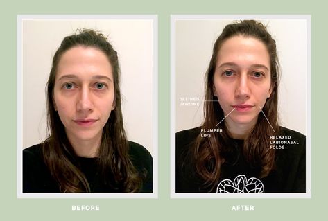 facial cupping before and after Facial Before And After, How To Do Facial, Nontoxic Beauty, Facial Cupping, Facial Yoga, Gua Sha Facial, Skin Regimen, Instant Gratification, Facial Exercises