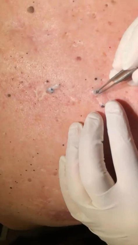 #acne#pimple #pimplesremoval #blackheads #NaturalRemediesForArthritis Popping Pimples Videos, Popping Pimples Videos Youtube, Pimple Popper Tool, Popping Pimples, Best Dark Spot Corrector, Clear Blackheads, Zit Popping, Zit Popping Videos, Clean Blackheads