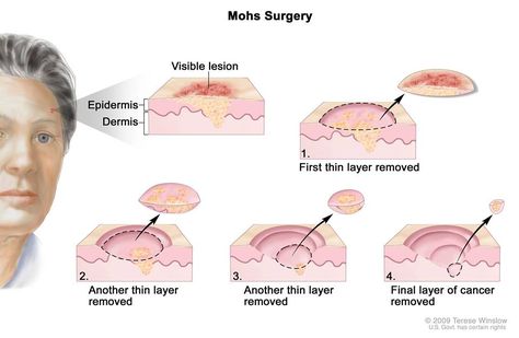 Basal Cell, Squamous Cell, Types Of Cancers, Cosmetic Surgery, Dermatology, Skin Treatments, Surgery, Skin