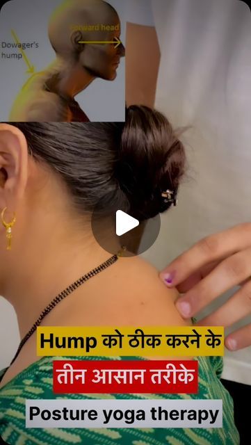 Exercise For Hunch Back, How To Reduce Neck Hump, Reduce Neck Hump Exercise, Hairstyles To Hide Neck Hump, Neck Hump Exercise, Posture Exercises Correction, Exercise For Neck Hump, Neck Hump Correction, Hump On Back Of Neck