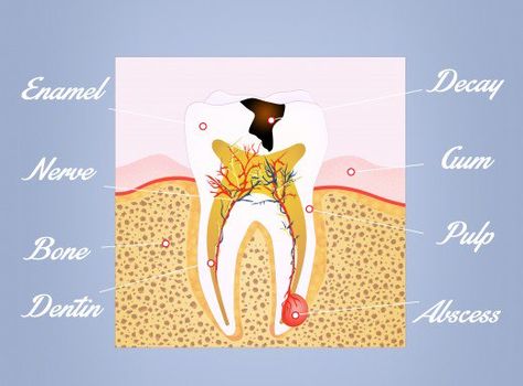 Absessed Tooth, Abcessed Tooth, Facial Swelling, Abscess Tooth, Severe Tooth Pain, Tooth Pain Remedies, Wisdom Teeth Pain, Tooth Pain Relief, Tooth Nerve