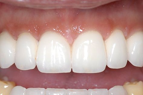 Dental Bridge Before and After - [ Images & Video ] Crown And Bridge Dental Teeth, Dental Bridge Before And After, Dental Bridge Front Teeth, Tooth Bridge, Bridge Pictures, Teeth Bonding, Denture Implants, Missing Tooth, Veneers Teeth