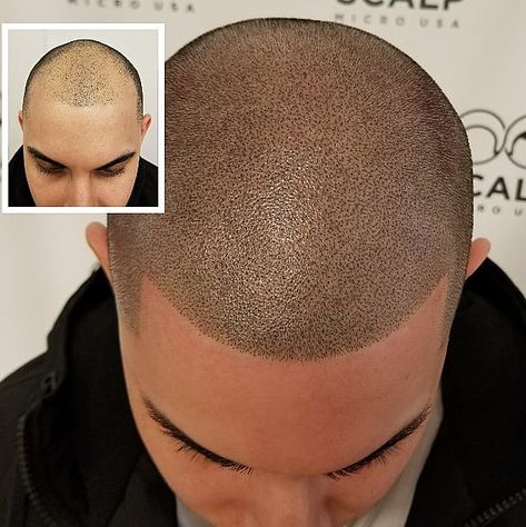 Head Tattoo Hair, Hair Pigmentation, Hairline Tattoos, Scalp Tattoo, Tattoo Hair, Scalp Micropigmentation, Head Tattoo, Bald Hair, Cosmetic Tattoo