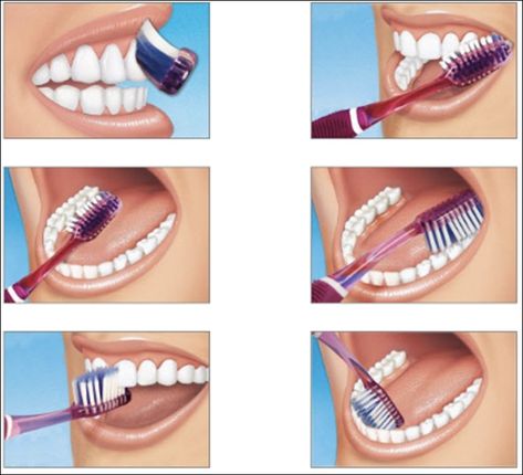 Brushing Technique, Remedies For Tooth Ache, Dental Posters, Tooth Brushing, Kedokteran Gigi, Sikat Gigi, Dentist Humor, Dental Life, Brush Type