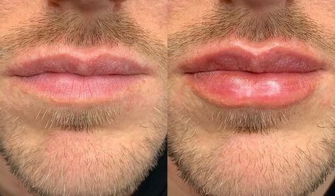 Serge A. Steenen, MD DDS (@dr_steenen) posted on Instagram: “Male lips by doctor Serge A. Steenen, MD DDS . 🇳🇱 . #masculine #masculinity #malemodel #man #lipfillers #lip #lips #beauty #faceland…” • Mar 13, 2020 at 5:21pm UTC Mens Lips, Man Lips, Men Lips, Male Lips, Filler Ideas, People Reference, Facial Contouring, Guys Eyebrows, Lip Filler