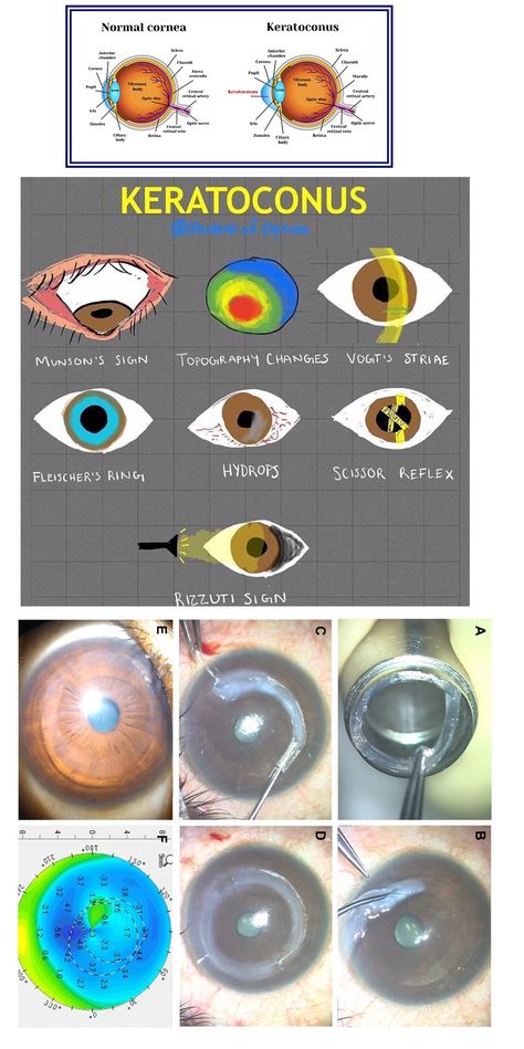 Cornea Eye, Eye Health Facts, Optometry Education, Optometry School, Eye Diseases, Eye Facts, Eye Anatomy, Nursing School Essential, Big Data Technologies