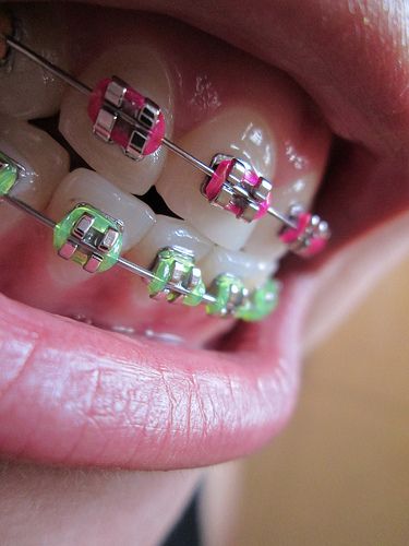 Pink And Green Braces, Braces Colors Pink, Mint Green Braces, Neon Pink Braces, Blue And Purple Braces Teeth, Light Blue And Pink Braces, Braces Cute, Braces Retainer, Pink Braces