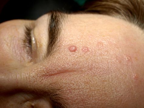 Seborrhoeic keratosis is a common, harmless skin growth. It can also be known as basal cell papilloma, senile wart, brown wart, age spots or barnacle. Sebaceous Hyperplasia, Seborrheic Keratosis, Warts On Face, Rare Genetic Disorders, Dry Oily Skin, Remove Skin Tags Naturally, Basal Cell, Skin Growths, Bumpy Skin