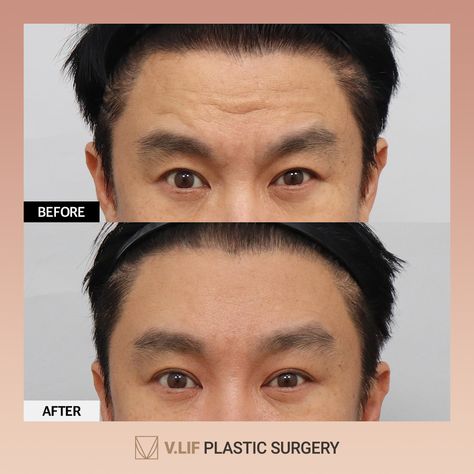 aesthetic surgery antiwrinkles smas plastic surgery before and after forehead lift cosmetic surgery clinic endoscopic brow lift loose skin removal youthful vlif plastic surgery Loose Skin Removal, Endoscopic Brow Lift, Forehead Lift, Aesthetic Surgery, Brow Lift, Loose Skin, Cosmetic Surgery, Plastic Surgery, Surgery