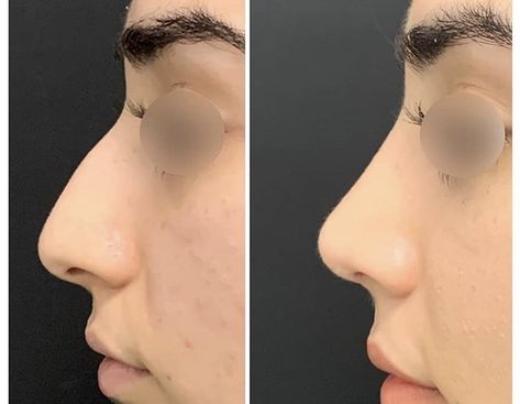 Rhinoplasty Front View, Nose Job Inspiration Natural, Job Dream, Nose Types, Nose Jobs, Rhinoplasty Nose Jobs, Job Inspiration, Straight Nose, Pretty Nose