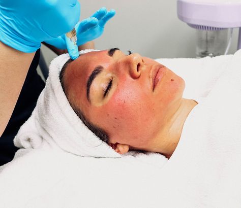 Prp Facial, Plasma Facial, Microneedling With Prp, Spa Images, Vampire Facial, Aesthetic Dermatology, Micro Needling, Homemade Face Mask, Hydra Facial