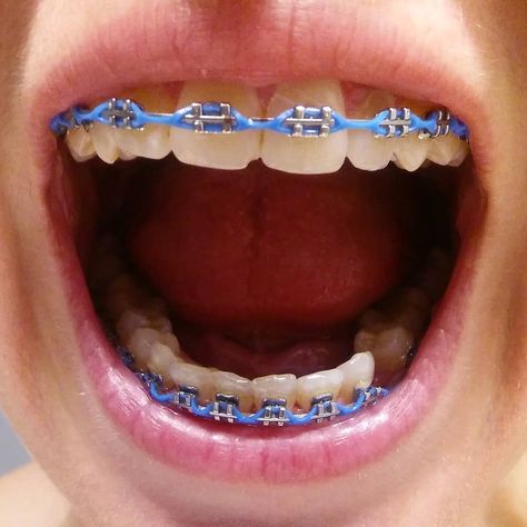 If you're unfamiliar with the process of getting braces, it will be beneficial to take a few moments to learn the overview of the process and what you can expect. Black Power Chain Braces, Chain Braces, Light Blue Braces, Power Chain Braces, Blue Braces, White Braces, Braces Color Wheel, Power Chain, Braces Cost