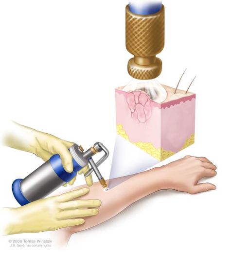 Cryosurgery relies upon the process of producing extremely cold temperatures using liquid nitrogen or argon gas in order to destroy diseased or abnormal tissue. The freezing temperature results in the formation of ice crystals in the diseased tissue which causes abnormal cells to tear apart. Abnormal Cells, Basal Cell, Skin Moles, Squamous Cell, Liquid Nitrogen, Skin Growths, Mole Removal, Tattoo Removal, Skin Treatments