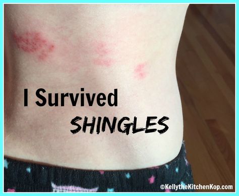 Today I'm sharing the best natural remedies for shingles that WORK -- this is what I used, and thankfully my case remained nice and mild! Shingles Remedies, Essential Oils For Shingles, Treating Shingles, Shingles Relief, Herbal Remedies Recipes, Home Health Remedies, Homeopathic Remedies, Immune Health, Health Articles