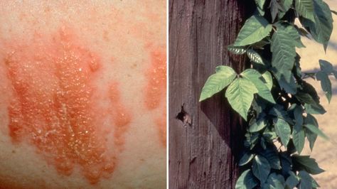 Sometimes a brush with nature leaves us red and itchy. Here's how to know if your summer skin rash needs immediate attention. Sun Poisoning Rash, Prickly Heat Rash, How To Dry Up Poison Ivy Rash, Poison Oak Rash, Poison Sumac Rash, Apple Cidar Vinegar, Poison Ivy Rash, Poison Ivy Plants, Red Moles