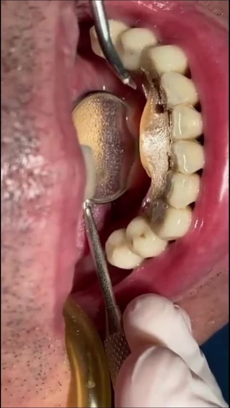 Unlock Your Smile: Effective DIY Tartar Remov #TartarRemoval #DentalCare #OralHealth #DentalHygiene #Tartar #HealthyTeeth #OralCare #DentalTips #TartarPrevention #SmileCare Remove Tartar From Teeth, Baby Tooth Decay, Tartar Removal, Healthy Morning Routine, Oral Care Routine, Gum Care, Oral Health Care, Dental Hygiene, Tooth Decay