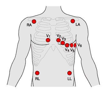 12 Lead ECG placement. | Medic School | Pinterest | Posts and Html Ekg Placement, Ecg Placement, Telemetry Nursing, Emt Study, Nursing Board, Emt Paramedic, Cardiac Nursing, Critical Care Nursing, Nursing School Studying