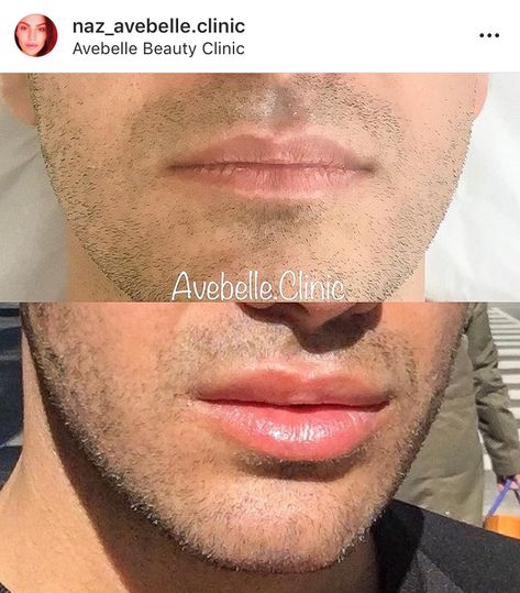 lip filler for men Men Lip Fillers, Mens Lip Filler, Male Lips, Lip Inspiration, Lip Ideas, Lips Inspiration, Facial Fillers, Facial Contouring, Guys Eyebrows