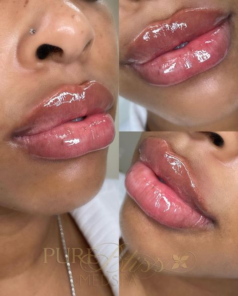 Lip Injections Black Women, Getting Lip Fillers, Lip Injections Before And After Black Women, Bratz Doll Lip Filler, Cosmetic Injectables Aesthetic, Lip Filler Before And After Black Women, Lip Injections Aesthetic, Lip Filler Black Women, Lip Inspo Filler