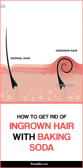 Ingrown Hair Remedies, Baking Soda Shampoo Recipe, Baking Soda For Hair, Bump Hairstyles, Ingrown Hair Removal, Baking Soda Benefits, Baking Soda Water, Homemade Shampoo, Hair Cleanser