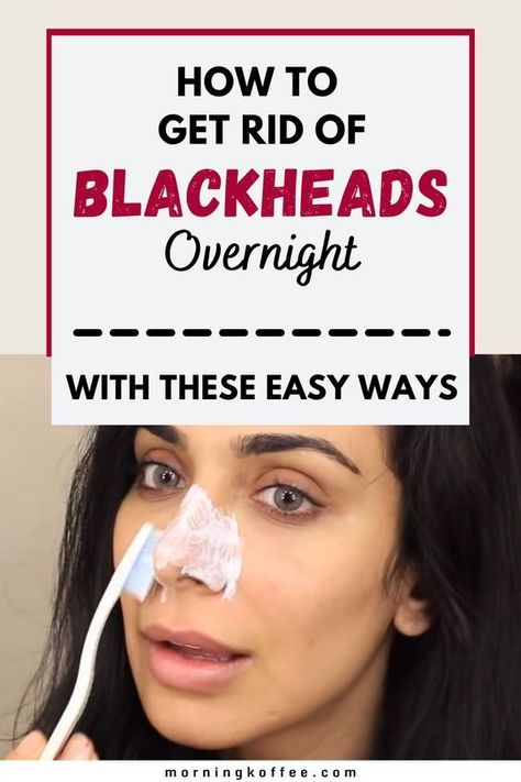 Get Rid Of Pores, Remove Blackheads From Nose, Blackheads On Nose, Rid Of Blackheads, Blackhead Mask, Types Of Acne, Get Rid Of Blackheads, Lose 40 Pounds, Blackhead Remover