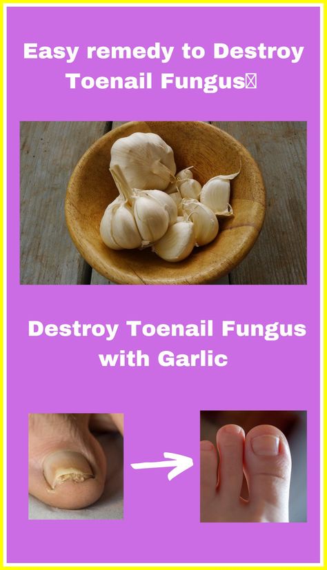 Tired of hiding your nails? Our garlic drops are here to save the day! 🌟 By harnessing the antifungal properties of garlic, our remedy fights nail fungus and promotes nail rejuvenation. Get ready to flaunt your beautiful nails again! 💅 #NailFungusGarlicDrops #ByeByeFungus #HealthyNailsAhead #GarlicPower #NailRejuvenation Garlic Remedies, Toenail Fungal Infection, Nail Remedies, Toenail Fungus Remedies, Nail Fungus Remedy, Fungal Nail, Nail Care Routine, Vibrant Nails, Ingrown Toe Nail