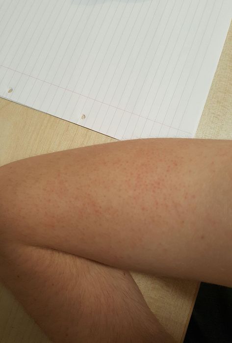 [Skin Concerns] I've got these red marks on my arms I think from where I've picked at dry skin around hair follicles. Anyone know how to clear this up? Hair Follicles, Red Marks, Very Funny Pictures, Hair Follicle, Skin Concern, Skin Conditions, Hair Videos, Dry Skin, Funny Pictures