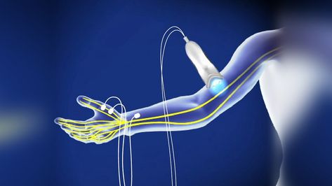 Nerve Conduction Study, Doctor On Call, Neurology, Nerve, Mumbai, Muscles, A Table, At Home