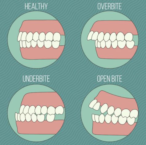 Normal teeth do not mean the upper teeth being parallel to the lower, instead the upper teeth come over the lower a little bit, like 1-2mm, both horizontally and vertically, which is called normal overbite or overjet. Only in this case, the function and aesthetics of the teeth can be guaranteed. Orthodontics Marketing, Dental Assistant Study, Orthognathic Surgery, Dental Check Up, Kedokteran Gigi, Kesehatan Gigi, Dental Hygiene School, Dental Anatomy, Dental Fun