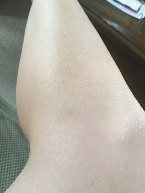 8-2-19: another bruise on the side of my left knee! Knee Bruising, On The Side