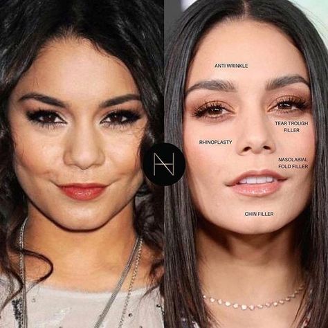 #cosmeticsurgery #tummytuck #antiaging #skin #celebritynews #aesthetic #filler #vanessahudgens #breastaugmentation #bbl #fashion #celebrity #lips #lipfillers #brazilianbuttlift #juvederm #botox #beauty #fillers #lipinjections #lipo #cosmetics #plasticsurgeon #skincare #medspa #liposuction #dermatology #plasticsurgery #aesthetics #lipo Kendall Jenner Plastic Surgery, Face Plastic Surgery, Filler Instagram, Celebrity Surgery, Rhinoplasty Nose Jobs, Face Fillers, Face Surgery, Facial Contouring, Facial Plastic Surgery