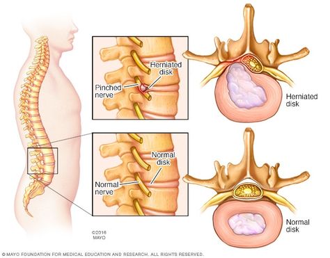 Herniated disk - Symptoms and causes - Mayo Clinic Anaerobic Respiration, Emt Study, Disc Herniation, Sciatica Symptoms, Lumbar Disc, Intervertebral Disc, Chronic Lower Back Pain, Disk Herniation, Spinal Nerve