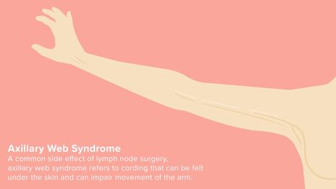 Axillary Web Syndrome: Cording After Breast Surgery Bilateral Mastectomy, Breast Surgery, Pregnant Diet, Losing Weight, Lose Belly Fat, Surgery, Need To Know