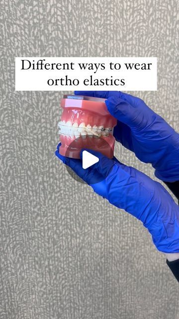 Different ways to wear your orthodontic elastics and how they help to move your teeth Braces With Rubber Bands, Fix Overbite, Orthodontics Teeth, Braces Rubber Bands, After Braces, Braces Bands, Braces Elastics, Diy Elastic, Getting Braces