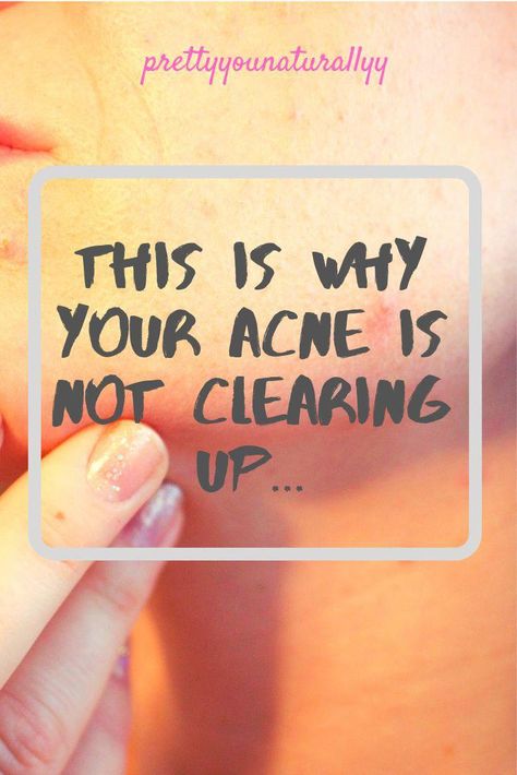 Acne Removal Overnight, Makeup Techniques Step By Step, Makeup Ideas For Blondes, Skin Care Routine Acne, Skin Tips For Acne, Acne Skin Care Routine, Get Rid Of Pores, Acne Hacks, Makeup Tutorials For Beginners