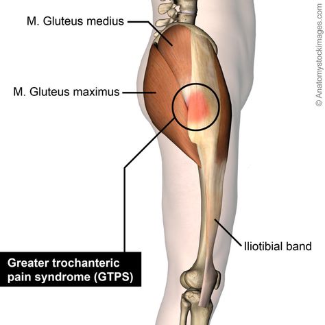 Why Does The Outside Of My Hip Hurt… & What to Do About It! | Lakeview Physio in Calgary, AB Greater Trochanteric Pain Syndrome, Best Exercise For Hips, Hip Anatomy, Calf Cramps, Bursitis Hip, Hip Pain Relief, Gluteal Muscles, Hip Surgery, Back Stretches For Pain