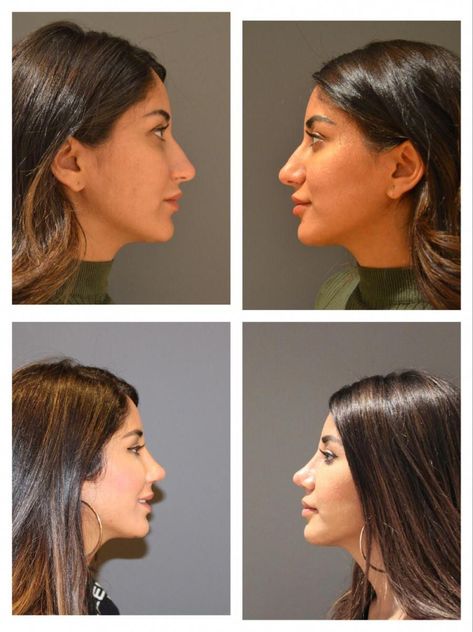 Select Your Nose Shape And Well Te Turkey Nose Job, Turkey Rhinoplasty, Bad Nose Jobs, Kpop Plastic Surgery, Jaw Reduction Surgery, V Line Surgery, Plastic Surgery Fail, Nose Jobs, Rhinoplasty Nose Jobs