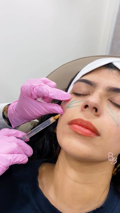 Under Eye Filler, Face Injections, Eye Filler, Dermal Fillers Lips, Facial Injections, Cosmetic Fillers, Esthetician Inspiration, Facial Procedure, Under Eye Fillers