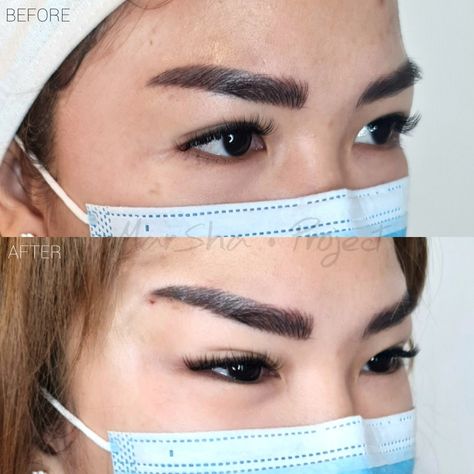 Cat Eye Surgery Before And After, Beauty Surgery, Brow Lift Surgery, Natural Skin Tightening, Nose Jobs, Rhinoplasty Nose Jobs, Dream Goals, Fox Eyes, Brow Lift