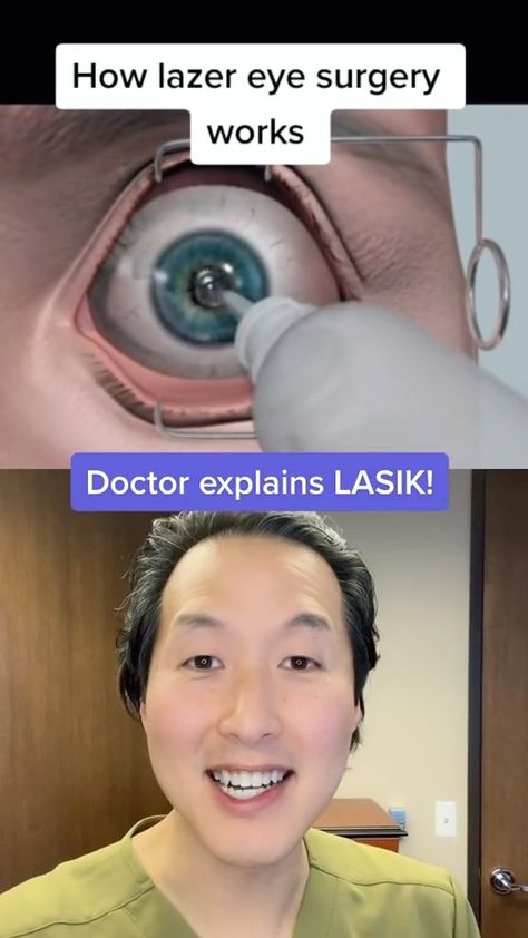 tonyyounmd on Instagram: How Lasik laser eye surgery works! Thanks to @_howthatworks for the video! . . . . #lasik #lasereyesurgery #lasereye #lasiksurgery… Eye Color Change Surgery, Eye Lightening, Laser Eyes, Lasik Eye Surgery, Laser Eye Surgery, Lasik Surgery, Laser Eye, Laser Surgery, Yag Laser