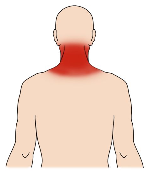 Neck Sprain - OrthoInfo - AAOS Neck Sprain, Sprains And Strains, Neck Traction, Isometric Exercises, Neck Injury, Stiff Neck, Moist Heat, Magnetic Resonance Imaging, Magnetic Resonance