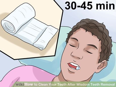 Image titled Clean Your Teeth After Wisdom Teeth Removal Step 1 Wisdom Teeth Removal Food, Wisdom Teeth Recovery, Tooth Pain Remedies, After Wisdom Teeth Removal, Tooth Pain Relief, Tooth Extraction Aftercare, Tooth Extraction Healing, Teeth Surgery, Tooth Pulled