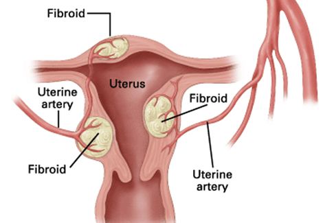 Fibroid Uterus, Surgery, Healthy Living