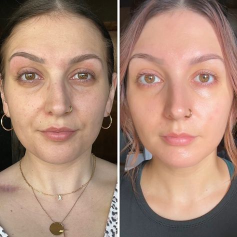 I. Am. Blown. Away. ➕ first click that F0LL0W ☑️ secondly SAVE this for later so you don’t lose this info! 6 months with Korean skincare has completely transformed my skin! 😳 Both same time of day & window (just different seasons aka winter vs summer so the sunlight is a little brighter in the afters) ✔️ Smoother skin. ✔️ Glowy, even & hydrated. ✔️ Reduced redness. ✔️ Brighter & tighter eyes. ✔️ Minimized pores. ✔️ Sun spots disappearing. ✔️ Elasticity improved. ✔️ Less breakouts & fast... Minimize Pores, Different Seasons, Smoother Skin, Time Of Day, Sell Out, K Beauty, Korean Skincare, My Skin, Clear Skin