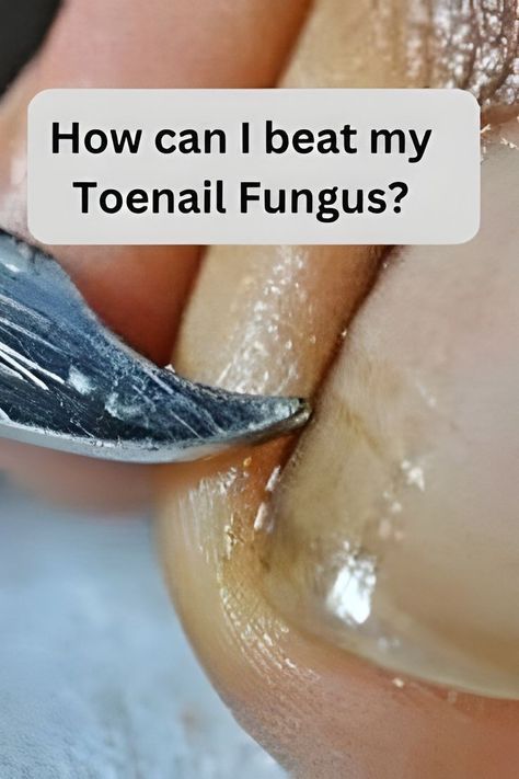 Fungal Nail Infections Homemade Nail Polish, Infected Toenail, Toenail Fungal Infection, Nail Remedies, Fingernail Fungus, Toenail Fungus Remedies, Nail Infection, Nail Fungus Remedy, Fungal Nail